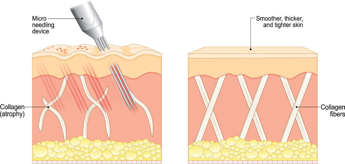Oppdag hvordan microneedling hjemme kan gi glødende hud, redusere rynker og forbedre hudtekstur. Komplett guide fra Glowtech